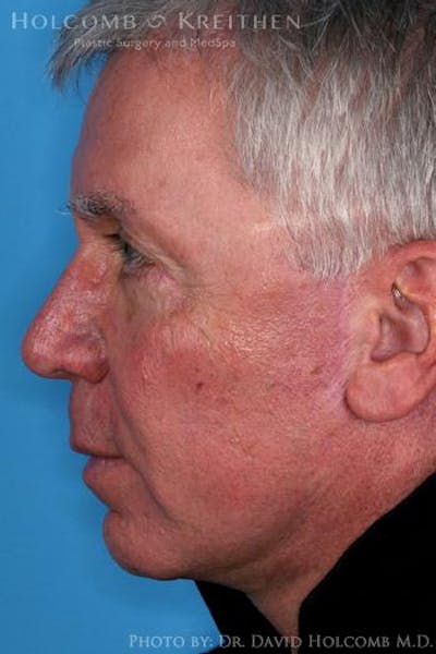 Cheek Implant Before & After Gallery - Patient 6279190 - Image 6