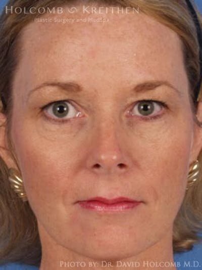 Brow Lift Before & After Gallery - Patient 6279222 - Image 1