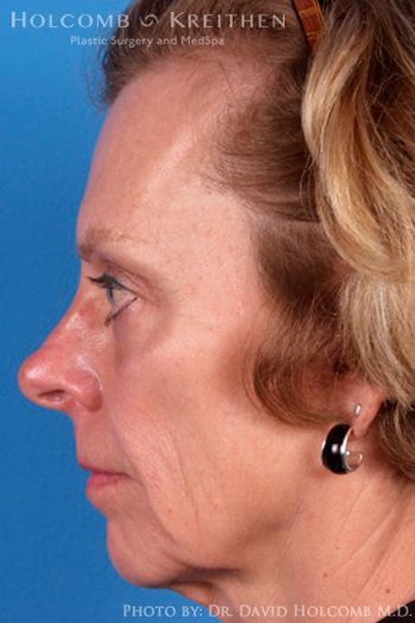 Cheek Implant Before & After Gallery - Patient 6279221 - Image 5