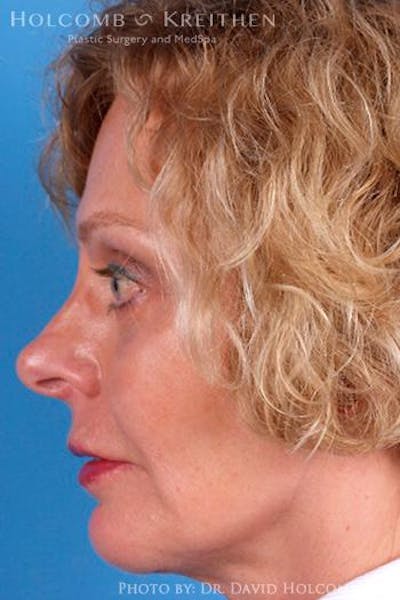 Cheek Implant Before & After Gallery - Patient 6279221 - Image 6