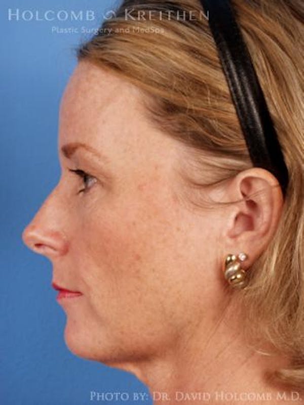 Brow Lift Before & After Gallery - Patient 6279222 - Image 5