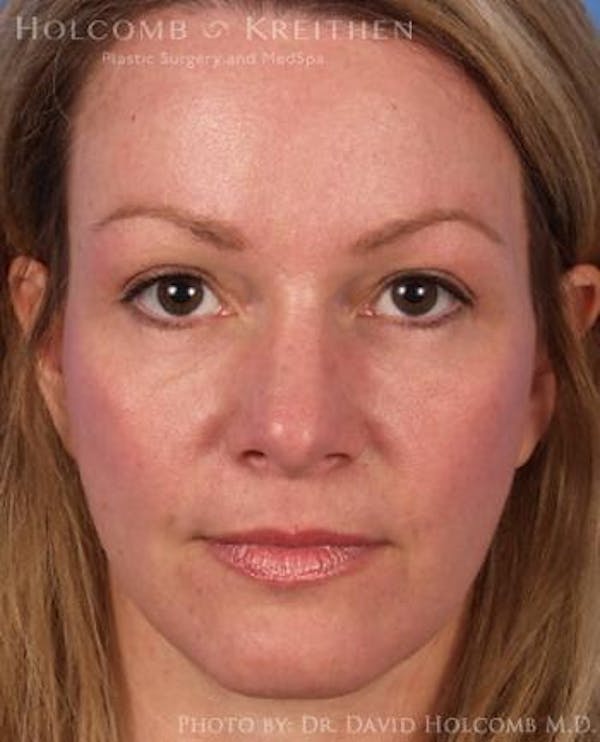 Brow Lift Before & After Gallery - Patient 6279225 - Image 2