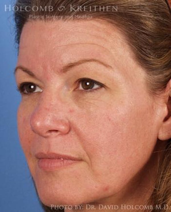 Brow Lift Before & After Gallery - Patient 6279225 - Image 3