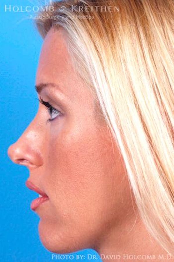Cheek Implant Before & After Gallery - Patient 6279224 - Image 5