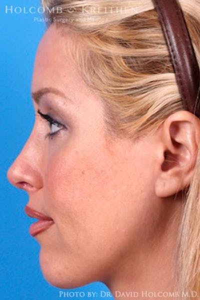 Cheek Implant Before & After Gallery - Patient 6279224 - Image 6