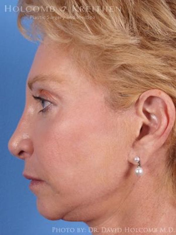 Chin Implant Before & After Gallery - Patient 6279226 - Image 5