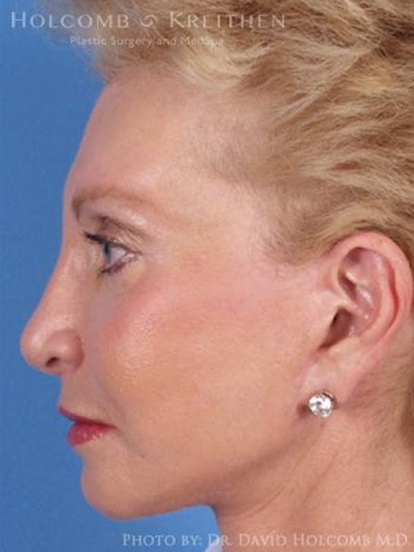 Chin Implant Before & After Gallery - Patient 6279226 - Image 6