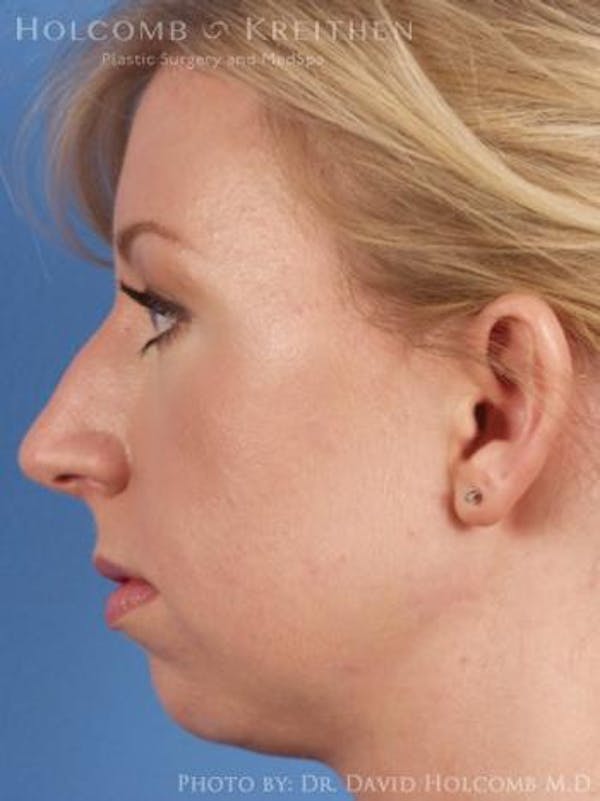 Chin Implant Before & After Gallery - Patient 6279232 - Image 5