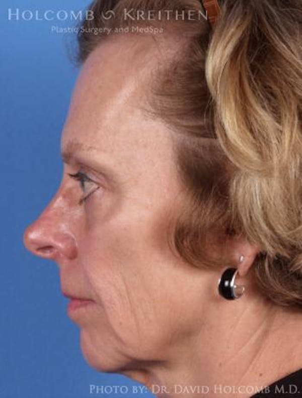 Chin Implant Gallery - Patient 6279236 - Image 5