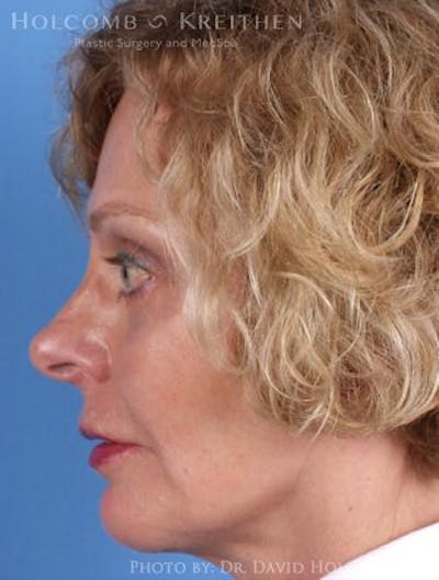 Chin Implant Before & After Gallery - Patient 6279236 - Image 6