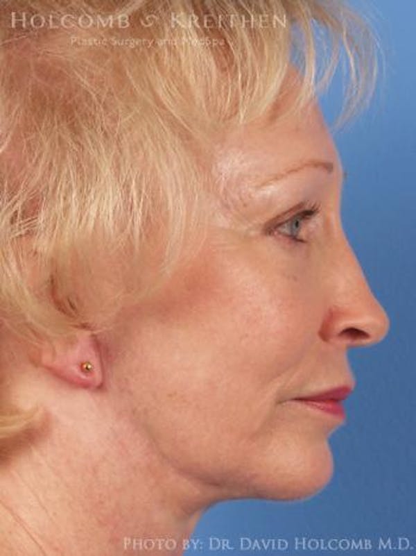 Chin Implant Before & After Gallery - Patient 6279240 - Image 6