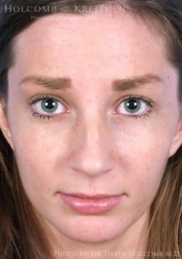 Lip Lift Before & After Gallery - Patient 6279247 - Image 1