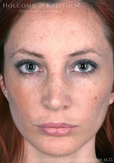 Lip Lift Before & After Gallery - Patient 6279247 - Image 4
