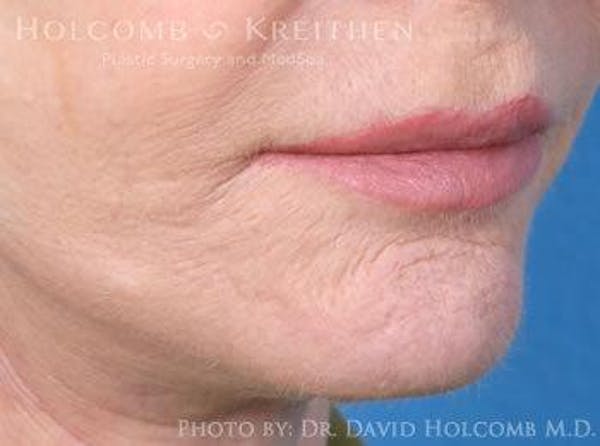 Lip Lift Before & After Gallery - Patient 6279251 - Image 4