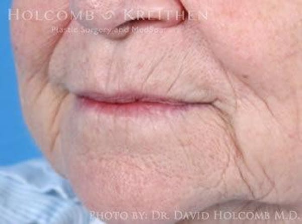 Lip Lift Before & After Gallery - Patient 6279256 - Image 3