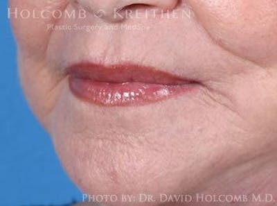 Lip Lift Before & After Gallery - Patient 6279256 - Image 4