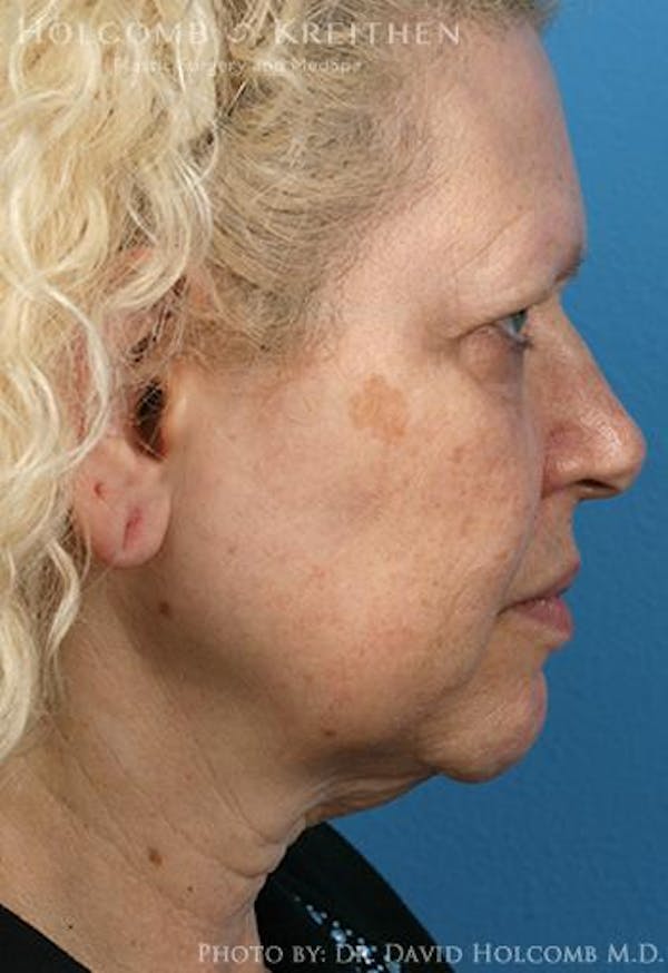 Neck Contouring Before & After Gallery - Patient 6279264 - Image 5