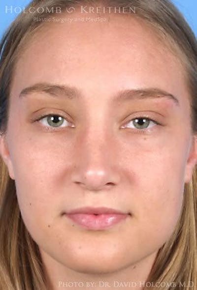 Rhinoplasty Before & After Gallery - Patient 6279295 - Image 2