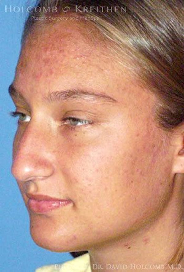 Rhinoplasty Before & After Gallery - Patient 6279295 - Image 3