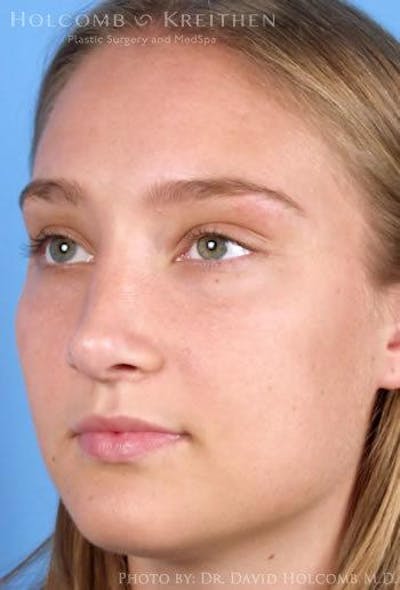 Rhinoplasty Before & After Gallery - Patient 6279295 - Image 4