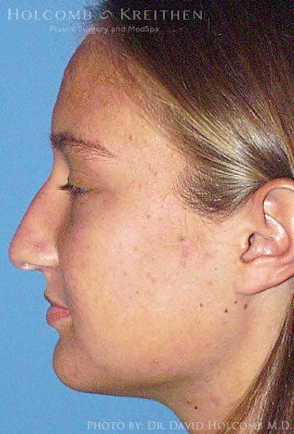 Rhinoplasty Before & After Gallery - Patient 6279295 - Image 5