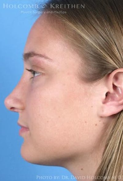 Rhinoplasty Before & After Gallery - Patient 6279295 - Image 6