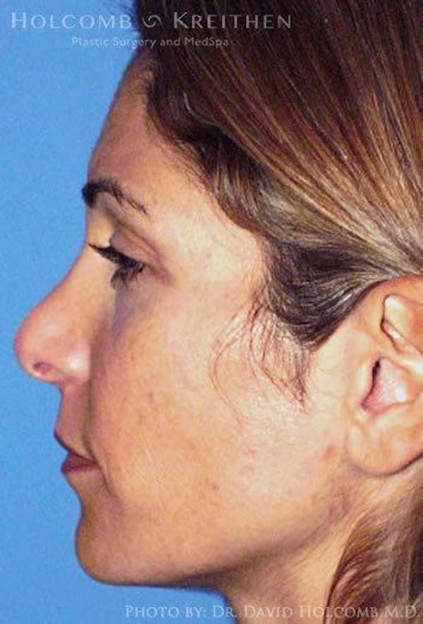 Rhinoplasty Before & After Gallery - Patient 6279299 - Image 5