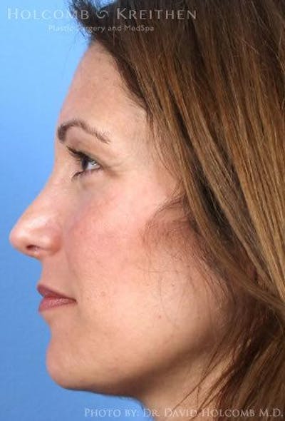 Rhinoplasty Before & After Gallery - Patient 6279299 - Image 6