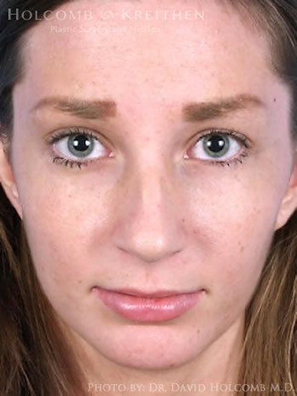 Rhinoplasty Before & After Gallery - Patient 6279301 - Image 1