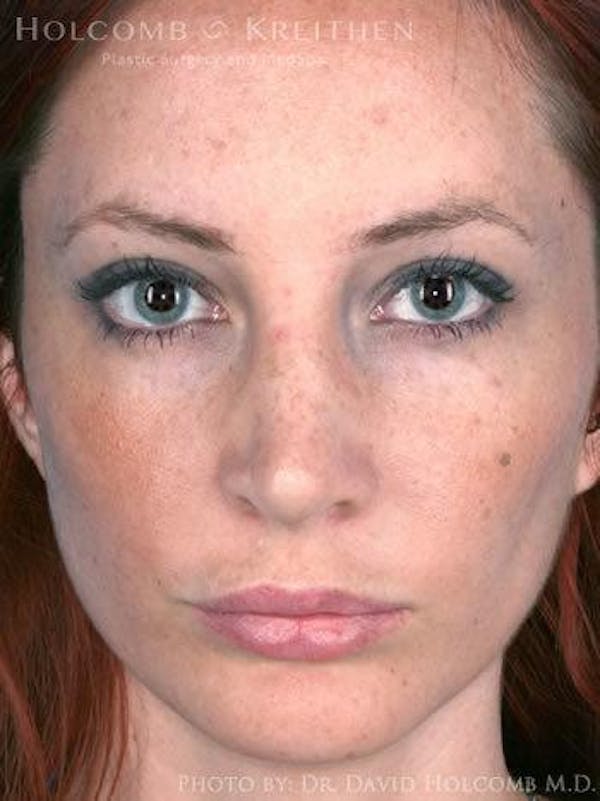 Rhinoplasty Before & After Gallery - Patient 6279301 - Image 2