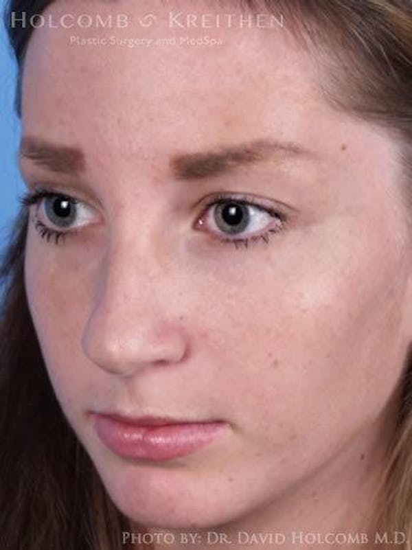 Rhinoplasty Before & After Gallery - Patient 6279301 - Image 3