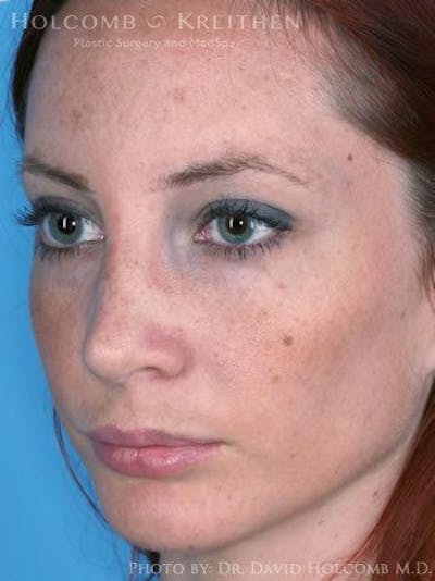Rhinoplasty Before & After Gallery - Patient 6279301 - Image 4