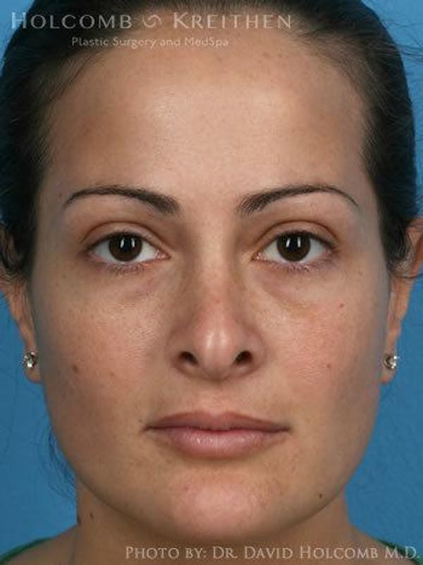 Rhinoplasty Before & After Gallery - Patient 6279308 - Image 1