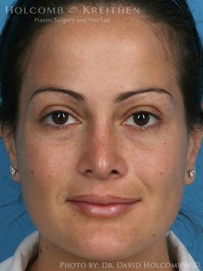 Rhinoplasty Before & After Gallery - Patient 6279308 - Image 2