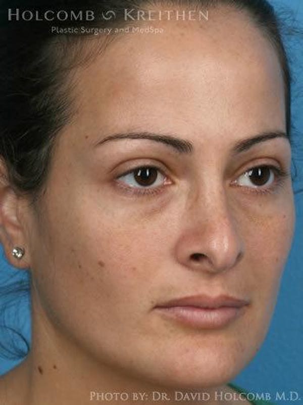 Rhinoplasty Before & After Gallery - Patient 6279308 - Image 3