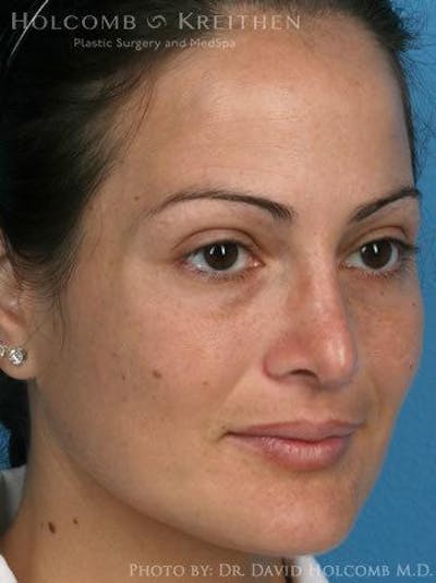 Rhinoplasty Before & After Gallery - Patient 6279308 - Image 4