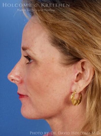 Neck Contouring Before & After Gallery - Patient 6279307 - Image 6