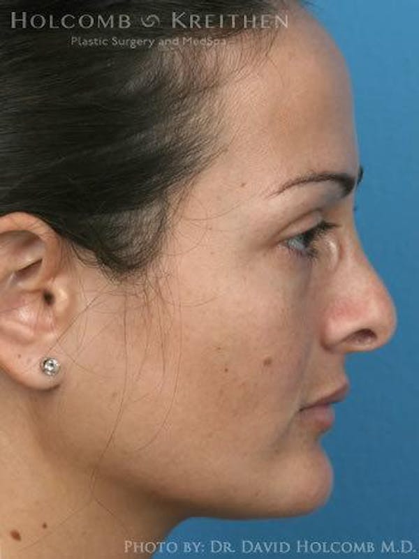 Rhinoplasty Before & After Gallery - Patient 6279308 - Image 5