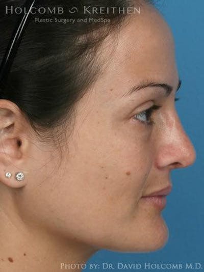 Rhinoplasty Before & After Gallery - Patient 6279308 - Image 6