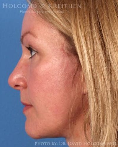 Neck Contouring Gallery - Patient 6279310 - Image 6