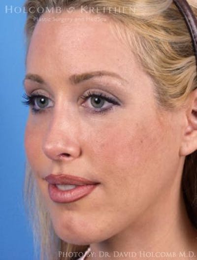 Rhinoplasty Before & After Gallery - Patient 6279311 - Image 4