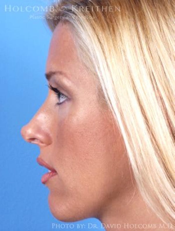 Rhinoplasty Before & After Gallery - Patient 6279311 - Image 5