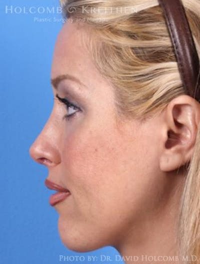 Rhinoplasty Before & After Gallery - Patient 6279311 - Image 6