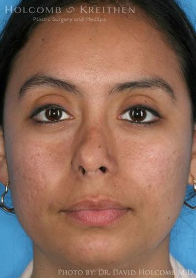 Rhinoplasty Before & After Gallery - Patient 6279328 - Image 1