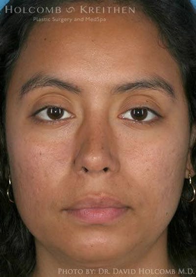 Rhinoplasty Before & After Gallery - Patient 6279328 - Image 2
