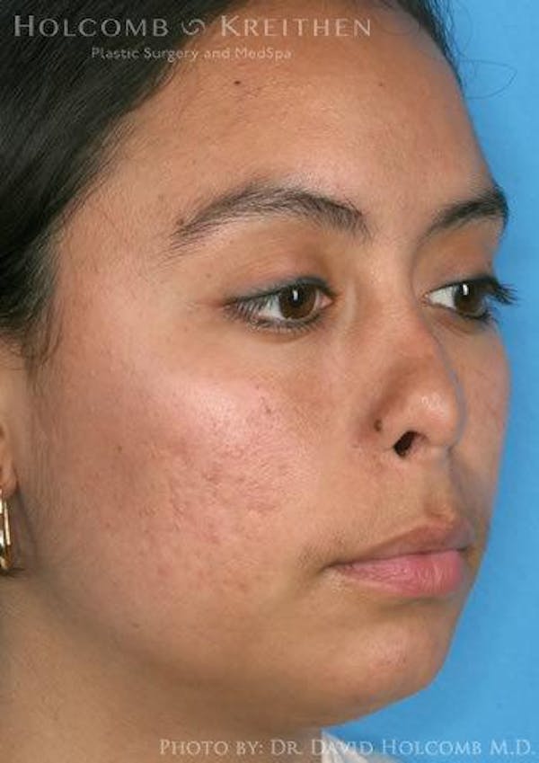 Rhinoplasty Before & After Gallery - Patient 6279328 - Image 3
