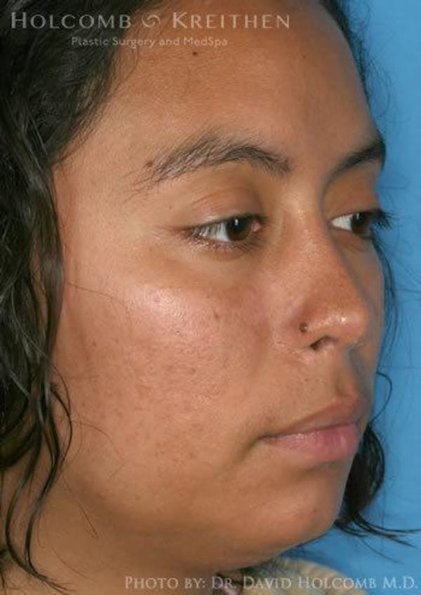 Rhinoplasty Before & After Gallery - Patient 6279328 - Image 4