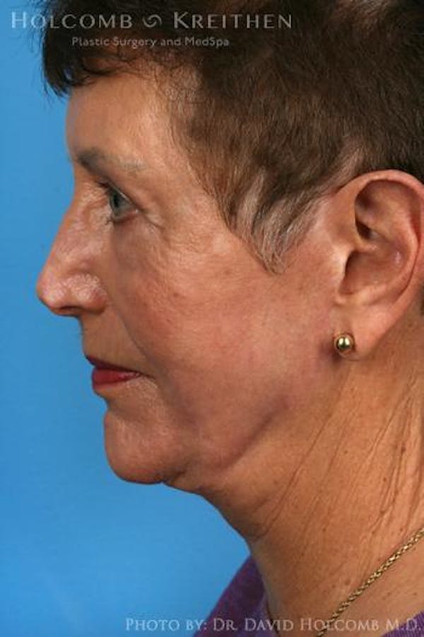 Neck Contouring Before & After Gallery - Patient 6279327 - Image 6