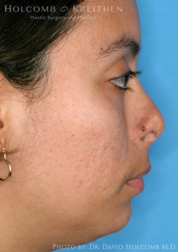 Rhinoplasty Before & After Gallery - Patient 6279328 - Image 5