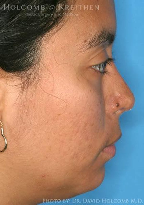 Rhinoplasty Before & After Gallery - Patient 6279328 - Image 6
